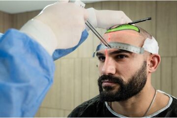 Hair Transplant Surgery